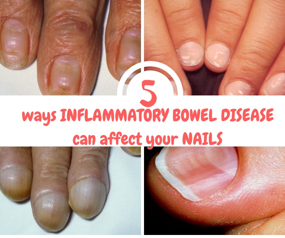 5 ways IBD can affect your nails — A Balanced Belly